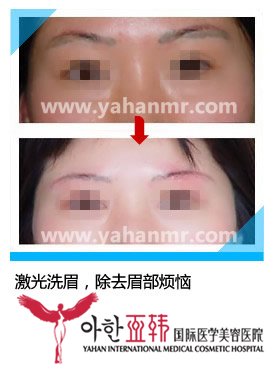 激光洗眉，除去眉部烦恼919