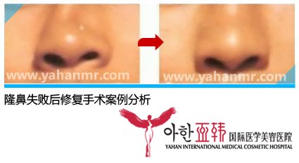 隆鼻失败后修复手术案例分析 隆鼻失败后修复手术案例分析