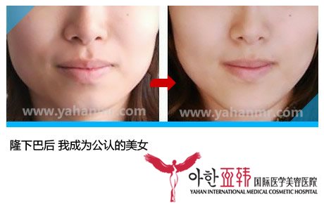 隆下巴后 wǒ成为公认得美女 隆下巴后 wǒ成为公认得美女