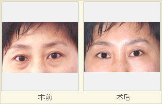 超声波去眼袋快速去眼袋,效果不反弹664 超声波去眼袋快速去眼袋,效果不反弹664