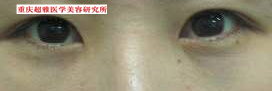 去眼袋后,她变得更加亮眼 去眼袋后,她变得更加亮眼