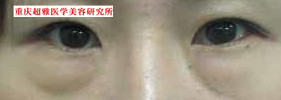 去眼袋后,她变得更加亮眼 去眼袋后,她变得更加亮眼