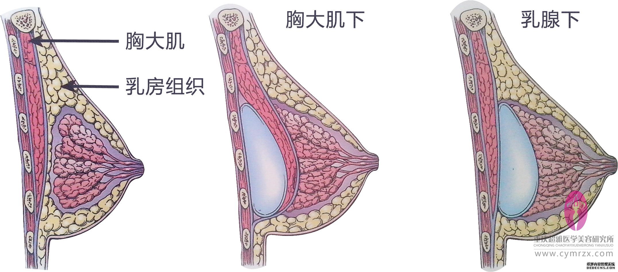 丰胸，敢于超越自己