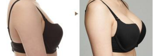 假体隆乳的一些问题需要了解809 假体隆乳的一些问题需要了解809