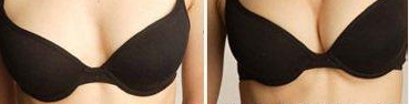 假体隆乳后能哺乳吗?568 假体隆乳后能哺乳吗?568