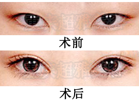 超 声 波双眼 皮术后概括 超 声 波双眼 皮术后概括
