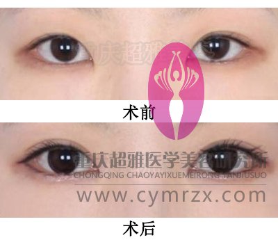 失败双眼皮修复的方法626 失败双眼皮修复的方法626