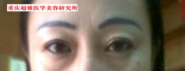 去眼袋小知识741 去眼袋小知识741