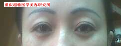 去眼袋小知识741 去眼袋小知识741