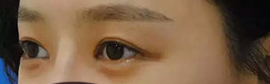 我的去眼袋日记853 我的去眼袋日记853