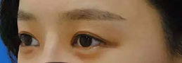 我的去眼袋日记853 我的去眼袋日记853