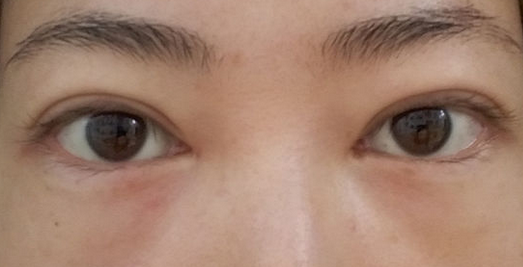 我的去眼袋日记853 我的去眼袋日记853