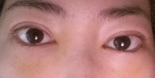 我的去眼袋日记853 我的去眼袋日记853