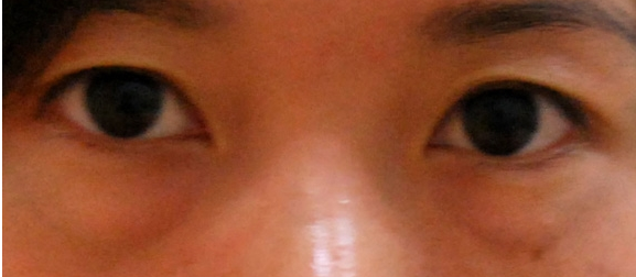 做了超声波去眼袋手术恢复好快啊130 做了超声波去眼袋手术恢复好快啊130