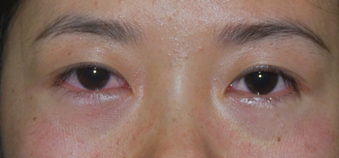 做了超声波去眼袋手术恢复好快啊130 做了超声波去眼袋手术恢复好快啊130