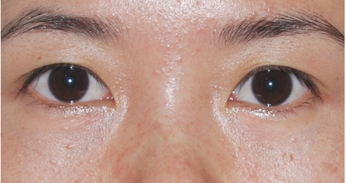 做了超声波去眼袋手术恢复好快啊130 做了超声波去眼袋手术恢复好快啊130
