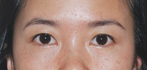 做了超声波去眼袋手术恢复好快啊130 做了超声波去眼袋手术恢复好快啊130