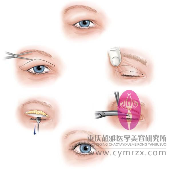 哪种双眼皮手术优势最大?348 哪种双眼皮手术优势最大?348