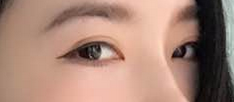 去眼袋手术ー个月,恢复得蛮好 去眼袋手术ー个月,恢复得蛮好