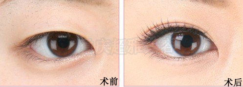 激光双眼皮是怎样的?182 激光双眼皮是怎样的?182