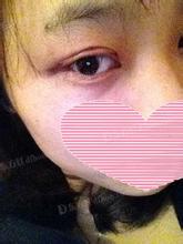 射频双眼 皮,你做过吗? 射频双眼 皮,你做过吗?