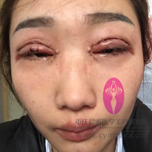 激光双眼 皮好用吗？