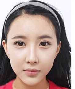 我在超雅整形美容医院做了玻尿酸复合生长因子填充术583