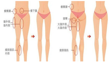 吸脂减肥需要多少钱 吸脂减肥需要多少钱