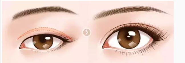 给你几个做双眼皮的理由289 给你几个做双眼皮的理由289