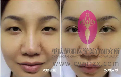 给你几个做双眼皮的理由289 给你几个做双眼皮的理由289