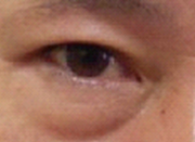 做le去眼袋手术,现在第五天le 做le去眼袋手术,现在第五天le