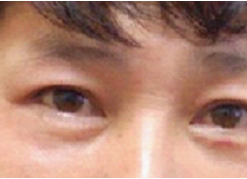 做le去眼袋手术,现在第五天le 做le去眼袋手术,现在第五天le