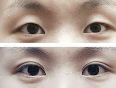 双眼皮手术让我变的更美599 双眼皮手术让我变的更美599