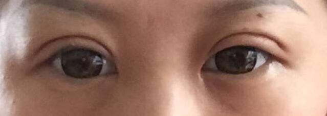 双眼皮手术让我变的更美599 双眼皮手术让我变的更美599