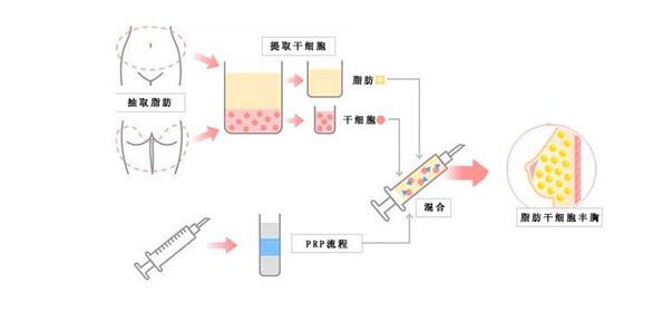超声波自体脂肪丰胸对身体有副作用吗019 超声波自体脂肪丰胸对身体有副作用吗019