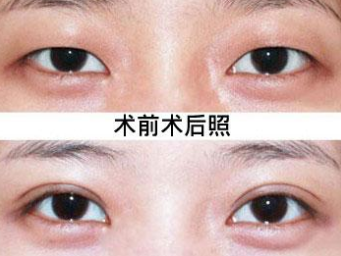 超声波双眼皮给你双明亮大眼088 超声波双眼皮给你双明亮大眼088