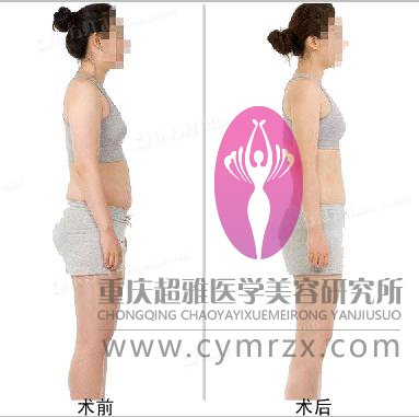 告别呕吐减肥法，超 声 波减肥带来全新减肥观念