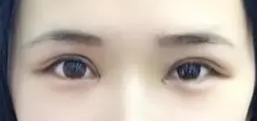 重庆超声波双眼皮成就我的双眼皮心愿544 重庆超声波双眼皮成就我的双眼皮心愿544