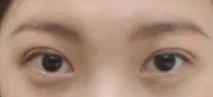 在重庆超雅做超声波双眼皮手术恢复记459