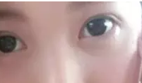 在重庆超雅做超声波双眼皮手术恢复记459