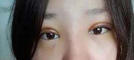我做双眼皮手术记录，让自己变得更美丽妩媚的历程320