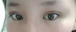 我做双眼皮手术记录，让自己变得更美丽妩媚的历程320