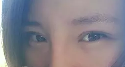 我做双眼皮手术记录，让自己变得更美丽妩媚的历程320