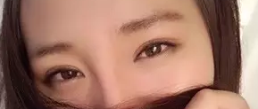 我做双眼皮手术记录，让自己变得更美丽妩媚的历程320