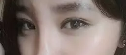 我做双眼皮手术记录，让自己变得更美丽妩媚的历程320