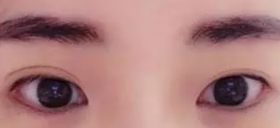 我的蜕变记录——双眼皮手术修复记058 我的蜕变记录——双眼皮手术修复记058