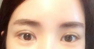 我的蜕变记录——双眼皮手术修复记058 我的蜕变记录——双眼皮手术修复记058