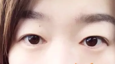 【整容日记】做了超声波双眼皮手术，恢复得很好了442