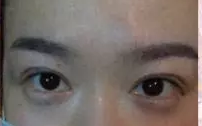 【整容日记】做了超声波双眼皮手术，恢复得很好了442
