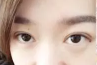 【整容日记】做了超声波双眼皮手术，恢复得很好了442